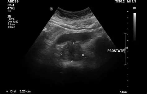 Endoanal Ultrasonography in Lucknow